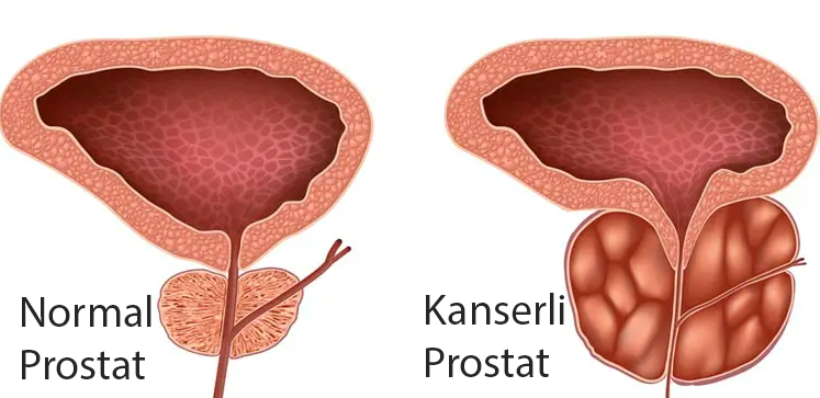 Prostat kanseri