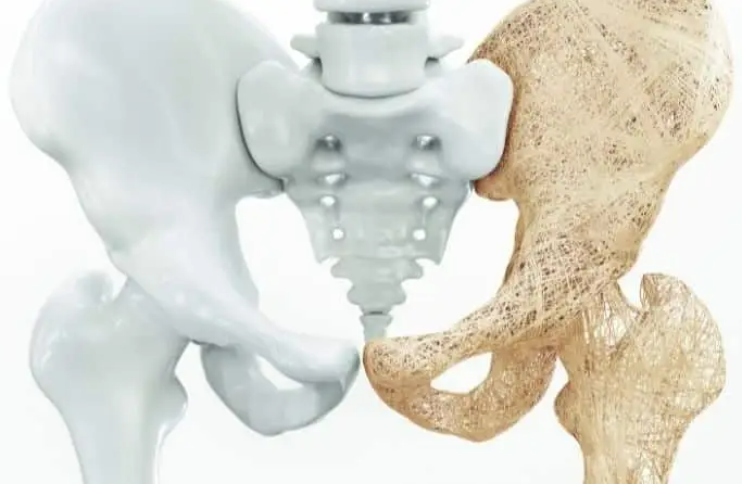 65 Yaş üstü kadınlar için osteoporoz ve kemik sağlığı 