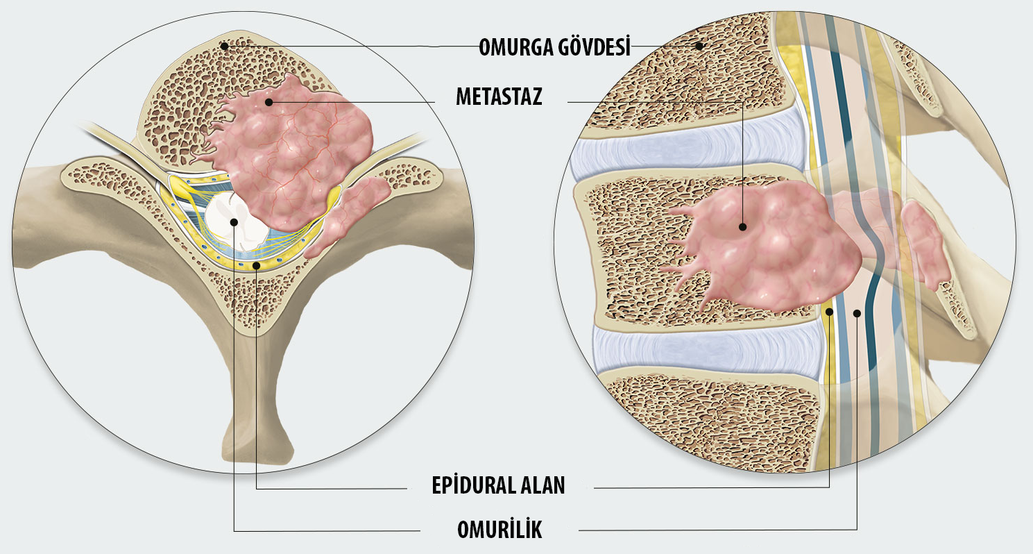 Omurga metastazında yeni tedaviler hayat kurtarıyor!