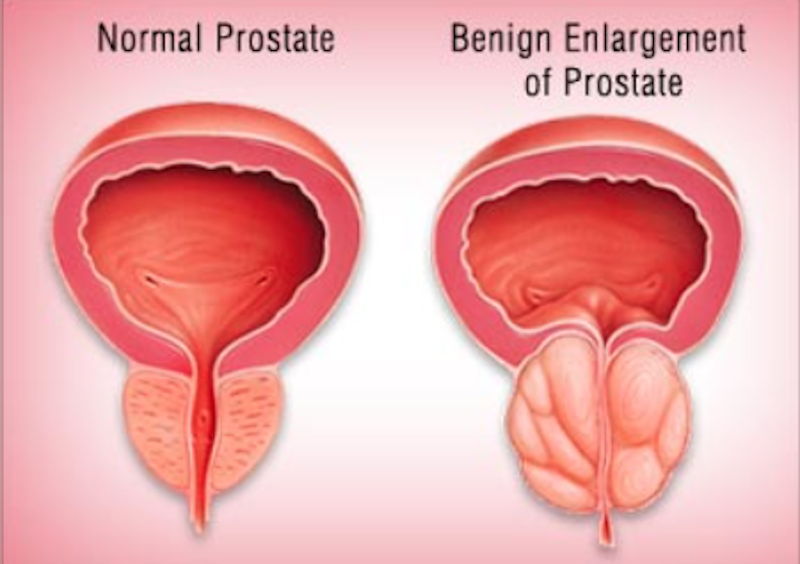 Prostat büyümesi genellikle hangi yaşlarda görülür? 