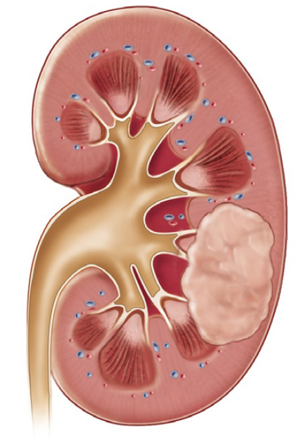 Böbrek tümörleri Belirtileri, tedavi süreci ve korunma
