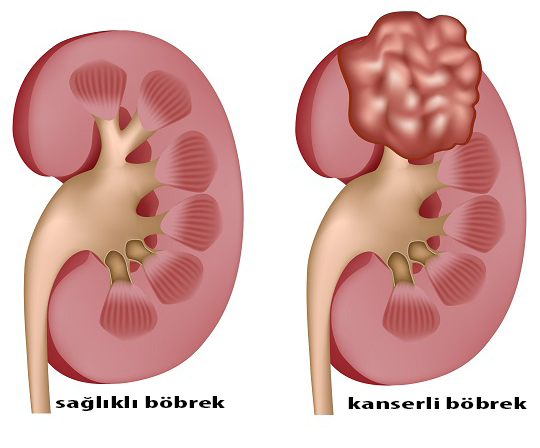 Böbrek tümörleri: Belirtileri, tedavi süreci ve korunma